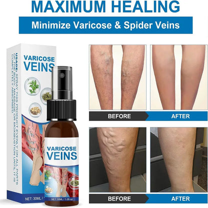Miracle Veins Spray